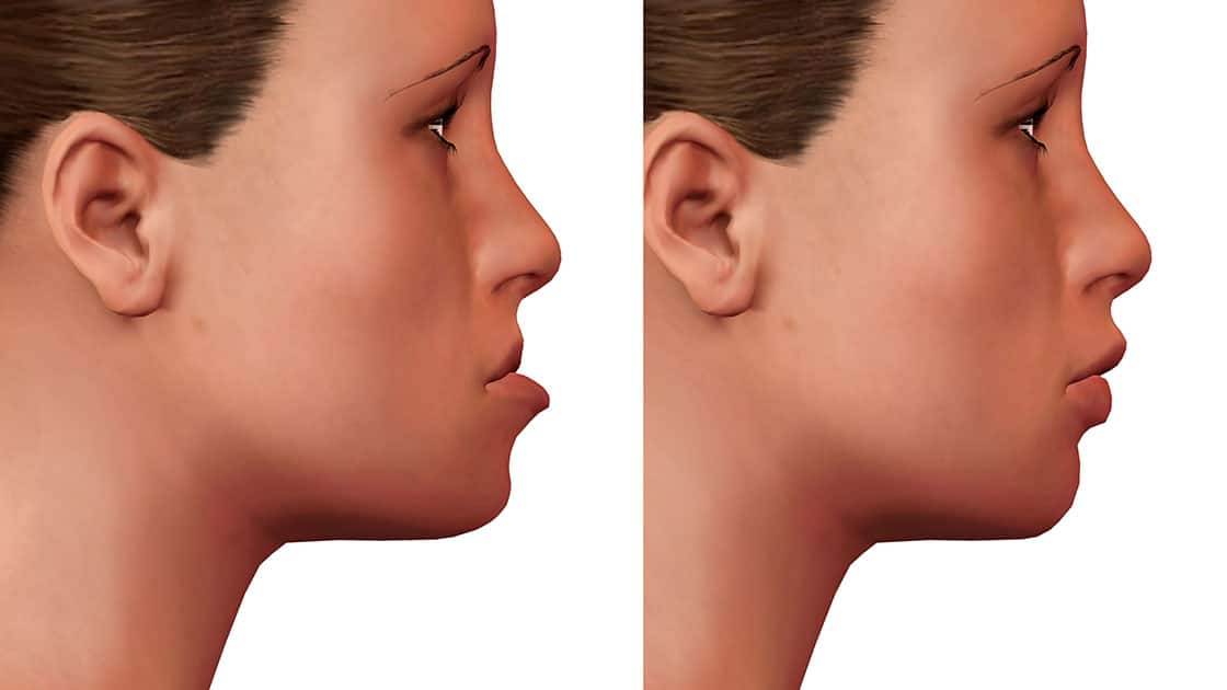 Orthognathic Surgery Photo